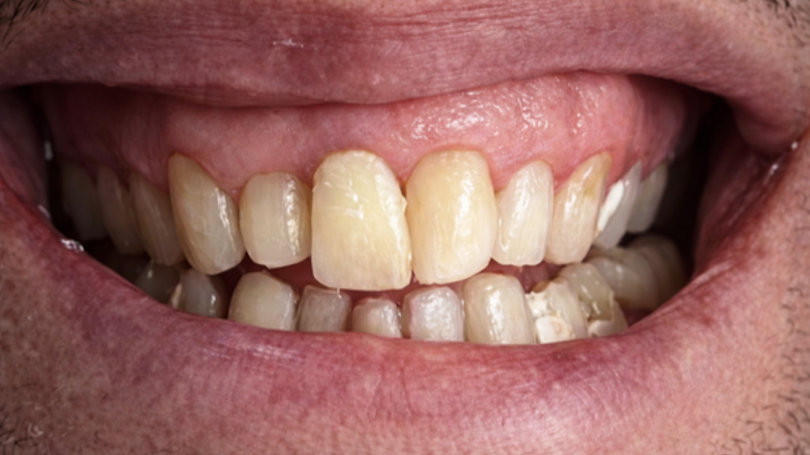 Sourire avant hollywood smile