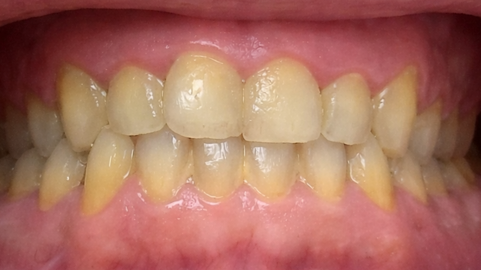 Sourire avant esthétique avancée