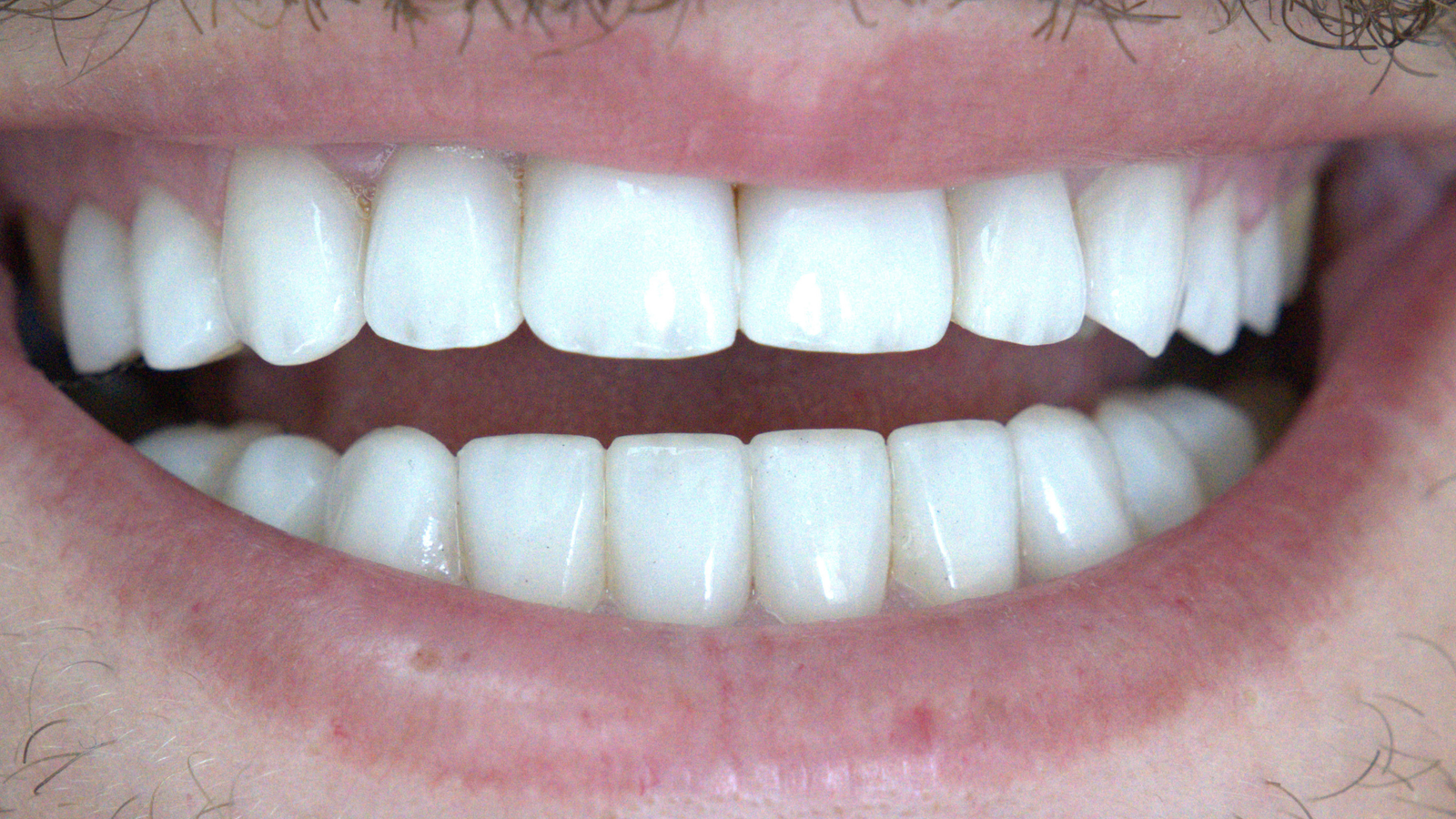 Sourire après esthétique avancée