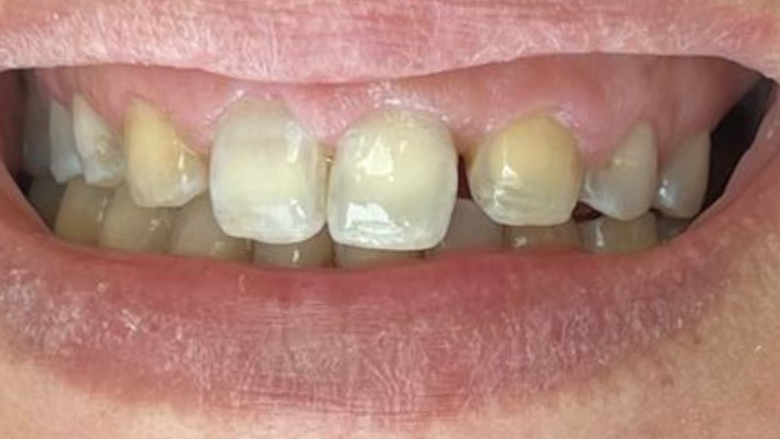 Sourire avant réhabilitation complète