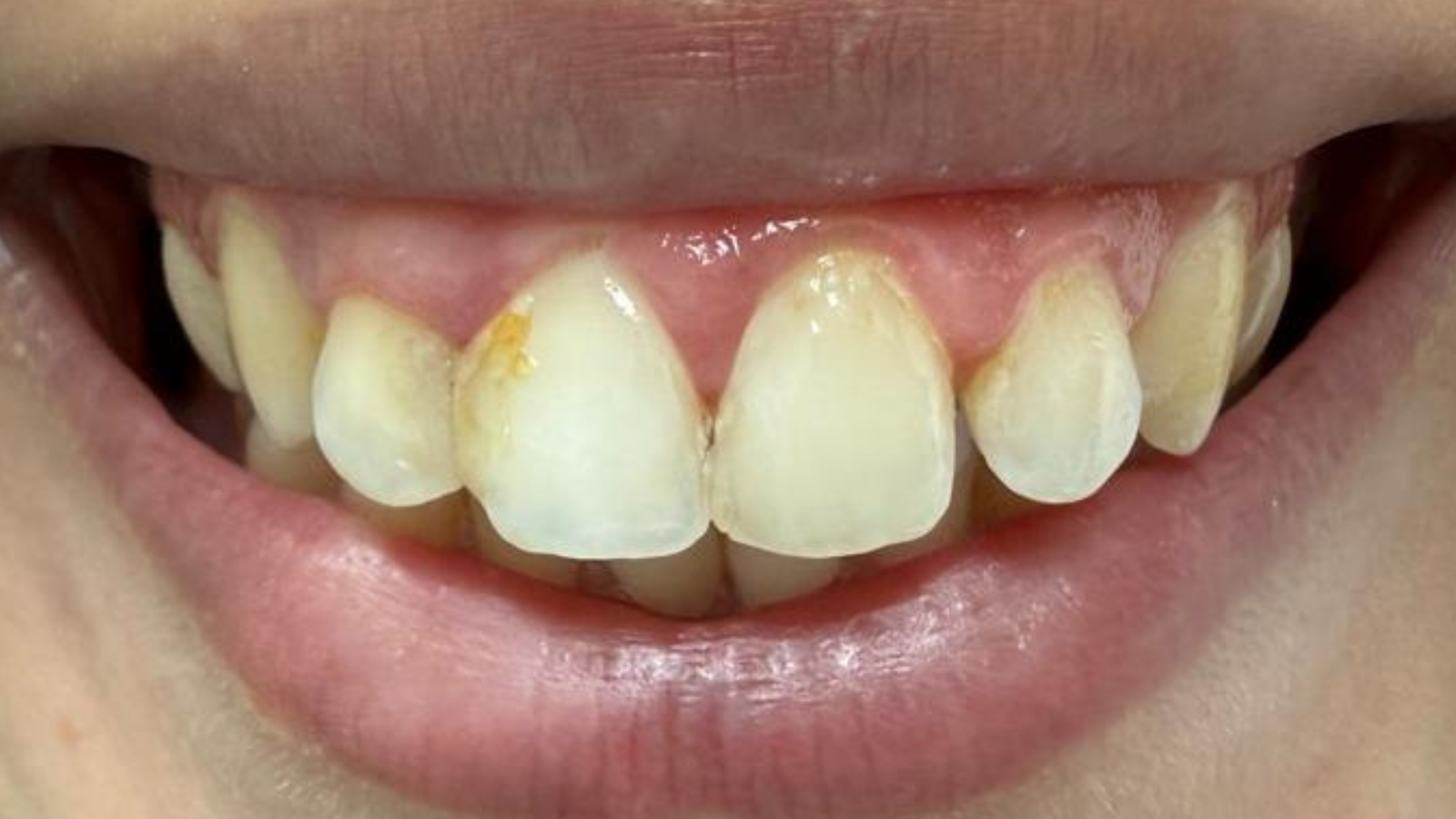 Sourire avant alignement orthodontique