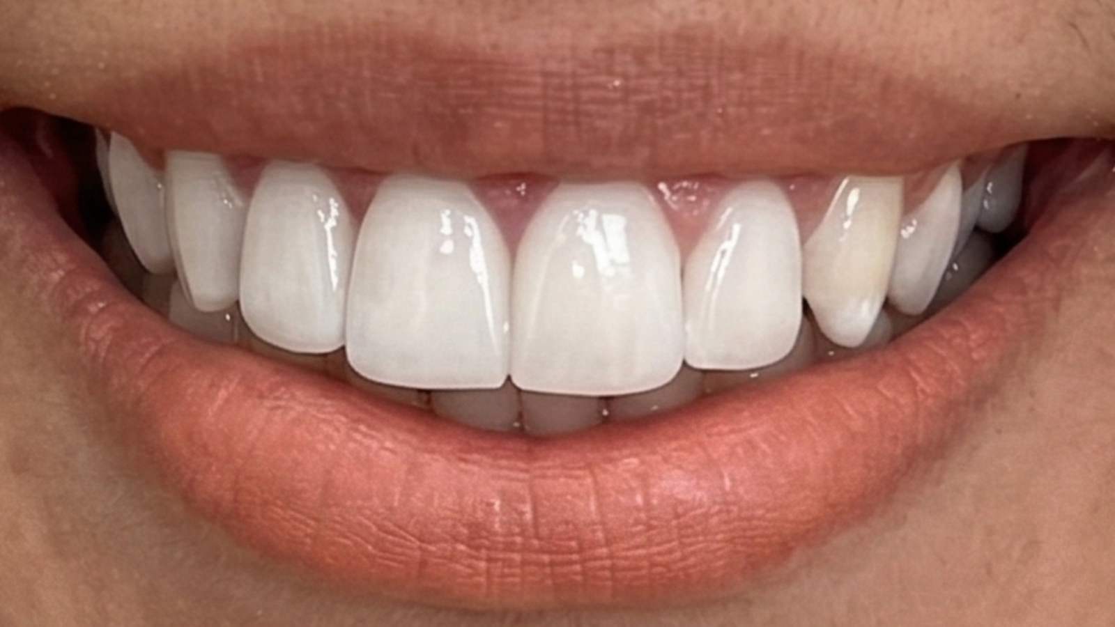 Sourire après alignement orthodontique